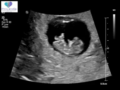 Baby ultrasound, pinned to the case file as Exhibit A